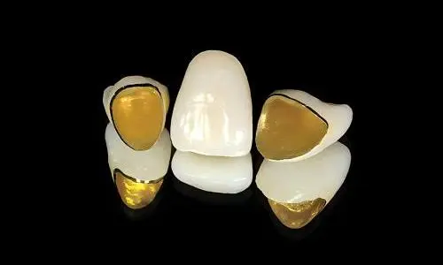 PFM Yellow Gold Offers Reliable Performance for Complex Crown and Bridge Cases